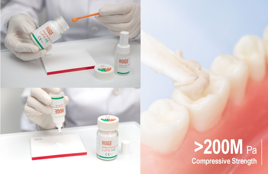 Glass Ionomer Cement Upgrade Plan