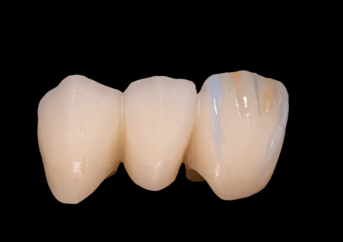 2. Digital Crown and Bridge Restoration