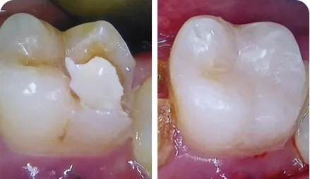 Direct Class II Composite Restoration of Endodontically Treated Tooth #36